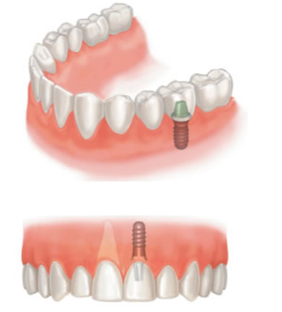 Dental Implants by Ainsdale Dental Practice